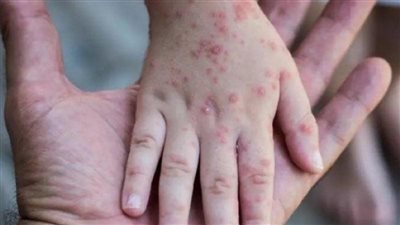 الأولى في أوروبا.. إسبانيا تعلن حالة وفاة بجدري القرود