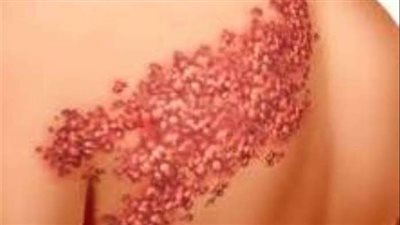 ما هو مرض الحزام الناري.. وأهم أعراضه وطرق العلاج 