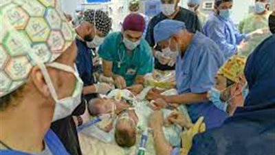 استغرقت 11 ساعة.. القصة الكاملة لفصل التوءم اليمني بالسعودية | صور