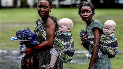 بالصور.. جزارو تنزانيا يصطادون ذوي البشرة البيضاء.. قتل «الألبينو» للحصول على «حظ جيد».. السحرة يستخدمون أجسادهم في «الشعوذة».. دفن عظامهم لتتحول إلى «ألماس».. 