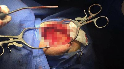 استئصال ورم بالمخ لمريض باستخدام الميكروسكوب في طنطا (صور)