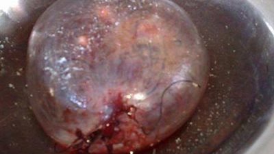 استئصال كيس مائي من مبيض امرأة يزن 10 كيلو بالشرقية