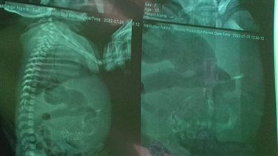 مدير مستشفى أطفال المنصورة يكشف تفاصيل حالة رضيعة تحمل جنينا في بطنها | صور 