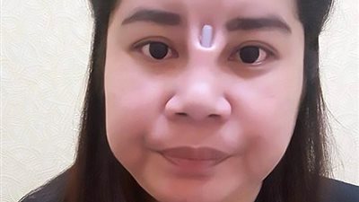 عملية تجميل رخيصة تشوه أنف فتاة (صور)