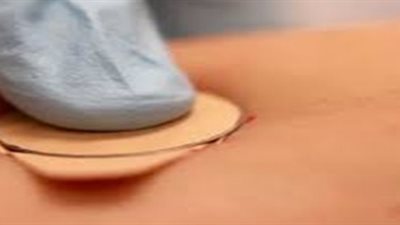 بشرى لمرضى السكر.. لاصقة جلدية بدلا من حقن الأنسولين