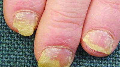 أسباب سقوط «الأظافر المرضي» وطرق العلاج