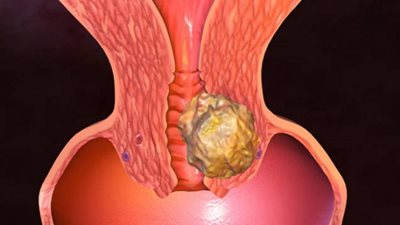 سرطان الرحم أعراضه صامتة وخطورته داهمة