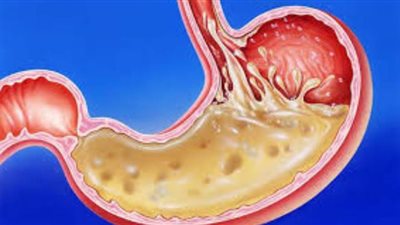 7 مشروبات ساخنة تريحك مت مشاكل المعدة بعد الإفطار في رمضان