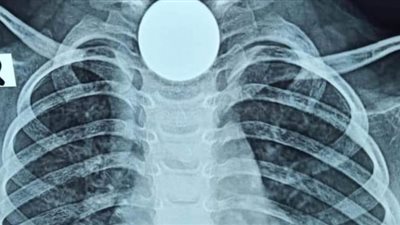 فريق طبي بمستشفى المنصورة ينجح في استخراج ٥٠ قرشا 