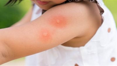 علاج حمي الضنك.. عليك بالسوائل