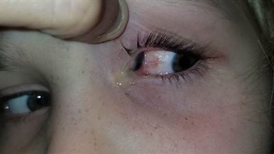 خنفساء تسكن داخل عين طفلة لمدة 9 ساعات | صور