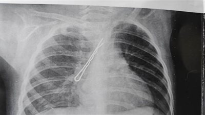 أطباء مستشفى سوهاج الجامعي ينقذون رضيعة بعد استخراج 