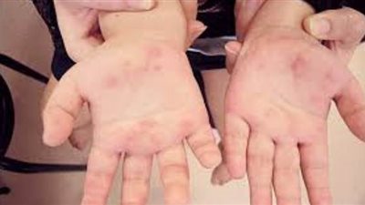 احذر.. الأطفال والمسنون أكثر عرضة للجفاف فى الصيف