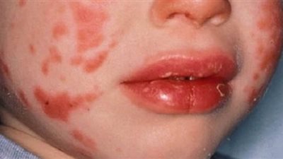 بدران: لا دليل حتى الآن على وجود صلة بين كورونا ومرض كاواساكى