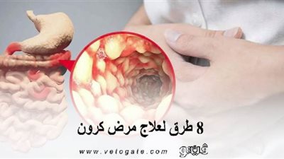 مرض كرون في مصر | 8 طرق لعلاج مرض كرون