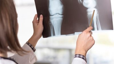 «القومي للبحوث» يتوصل لمنتج يعالج هشاشة العظام