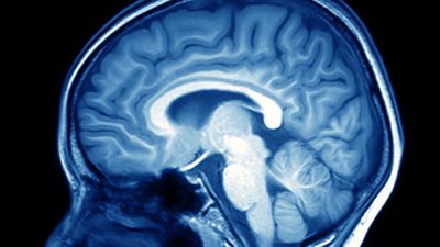 شريحة دقيقة تتبع مراحل تطور مرض هاننجتون المسبب لتلف خلايا المخ