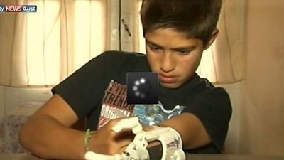 بالفيديو.. يد تعويضية بتقنية الطباعة ثلاثية الأبعاد