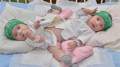 مشهد مؤثر.. إغماء أم التوأم السيامي بعد نجاح عملية الفصل بالسعودية| فيديو