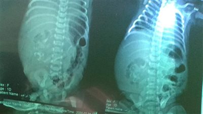 تحمل جنينا في بطنها.. تفاصيل جديدة عن حالة الطفلة الرضيعة بمستشفى جامعة المنصورة