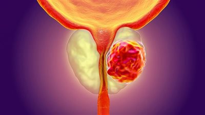 طرق الكشف عن سرطان البروستاتا