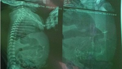 100 حالة في التاريخ.. باحث بطب نيويورك يكشف سر حمل طفلة المنصورة لتوأمها ببطنها 