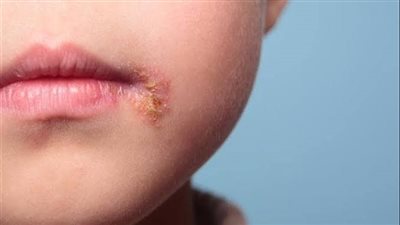  أسباب ظهور تقرحات بالفم وكيفية علاجها