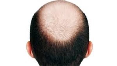 وداعا للصلع.. دراسة تتوصل لمادة تعيد نمو الشعر بعد تساقطه