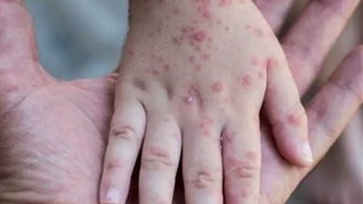 الهند تسجل أول إصابة بمرض جدرى القرود