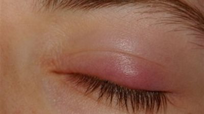 ماهي أسباب تورم جفون العين؟