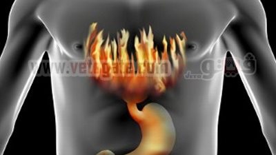 حموضة المعدة ومخاطرها