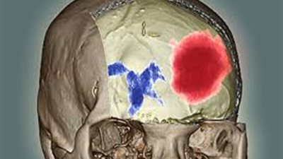الرجال مالكو جين الألزهايمر الأكثر عرضة للإصابة بنزيف المخ