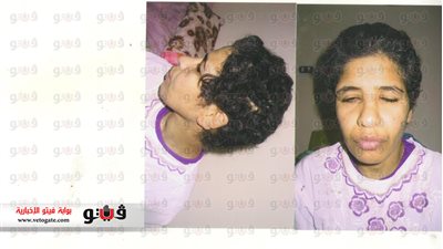 بالصور.. مأساة فتاة عذبتها زوجة أبيها بالنار وأجهضتها بوحشية بعد الاغتصاب